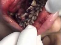 Żywe robaki w jamie ustnej pacjenta