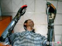 Męzczyzna stworzył dla siebie bioniczne ręce