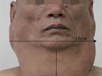Tak wygląda twarz mężczyzny który przez 30 lat pił prawie dziennie litr spirytusu