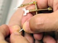 Japońska metoda prostowania wrastającego paznokcia